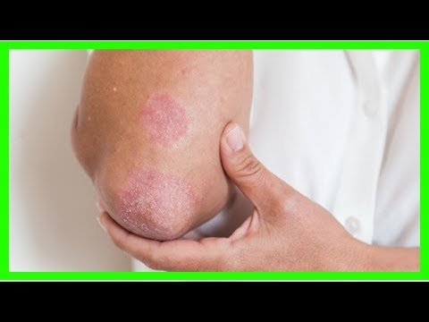 Видео о препарате Дипросалик (Diprosalic) фл. 30мл